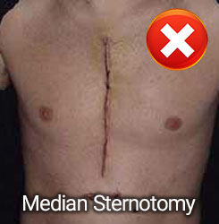 Median Sternotomy for Coronary Artery Bypass Grafting Surgery